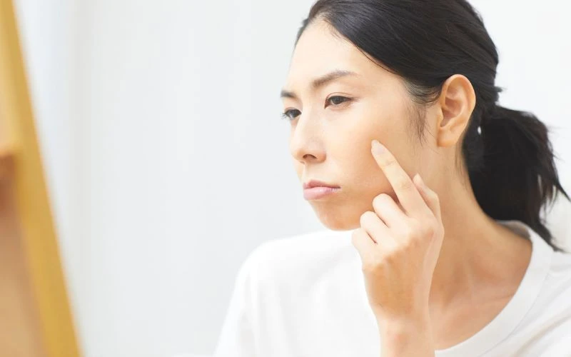 Bít tắt lỗ chân lông là một trong những tác hạị của dầu oliu với da mặt