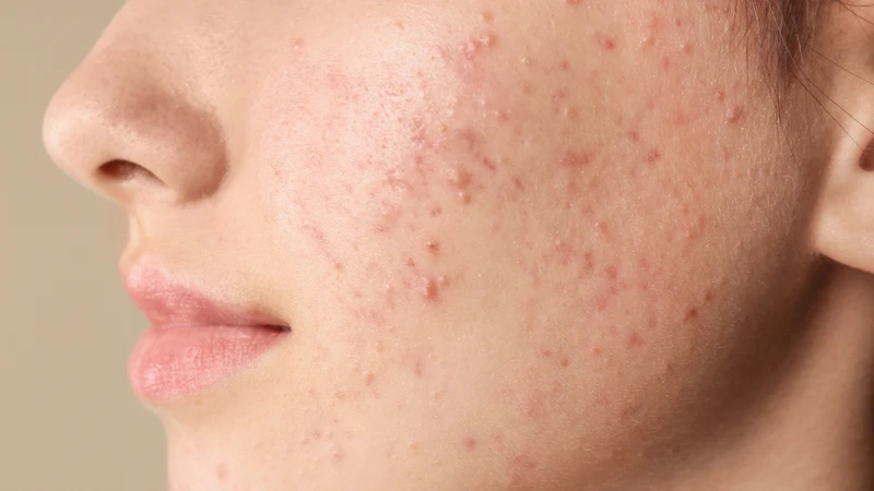 Lựa chọn sản phẩm trị mụn chuyên dụng khi bị mụn