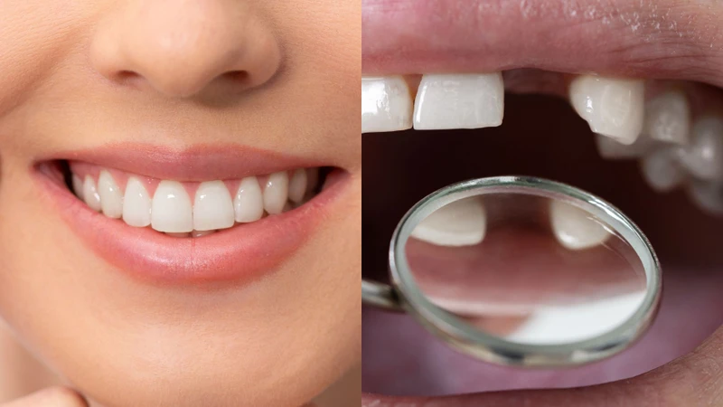 Tác hại của việc mất răng lâu năm có thể liên quan đến sự thay đổi vị trí răng và vùng xương hàm