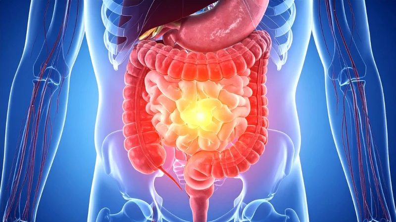 Tắc ruột có phải mổ không? Cách điều trị và những lưu ý quan trọng 1