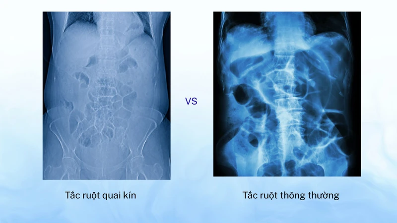 Hiểu rõ tắc ruột quai kín là gì giúp nhận biết tình trạng cấp cứu nguy hiểm