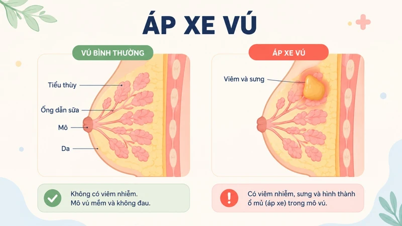 Viêm vú tiến triển có thể dẫn đến hình thành áp xe