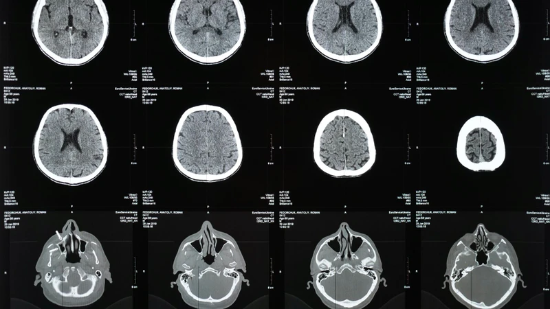 CT Scan sọ não là cận lâm sàng hình ảnh quan trọng giúp chẩn đoán bệnh đột quỵ