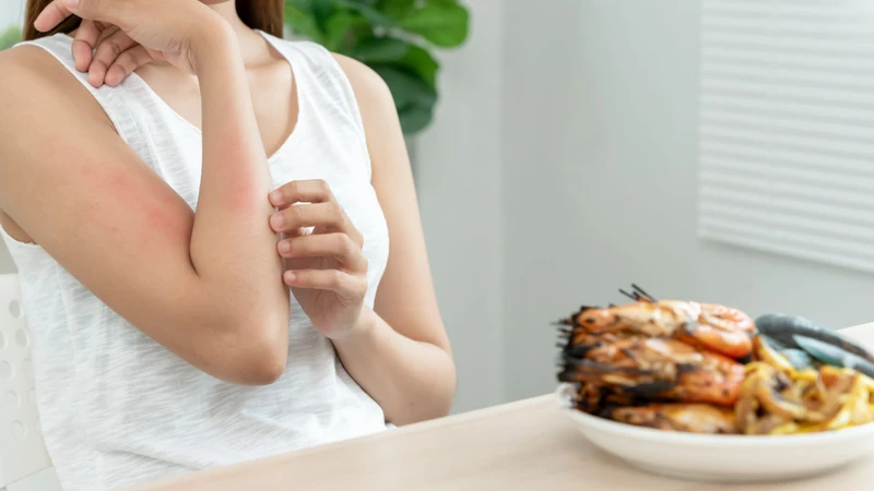 Sưng môi là một trong những dấu hiệu sớm của dị ứng thực phẩm