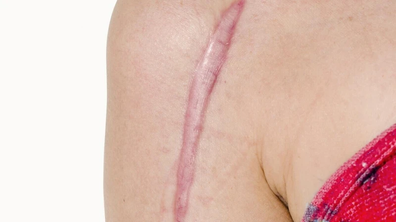 Đối với một số người thì lượng collagen sản sinh quá mức có thể dẫn đến sẹo lồi hoặc phì đại