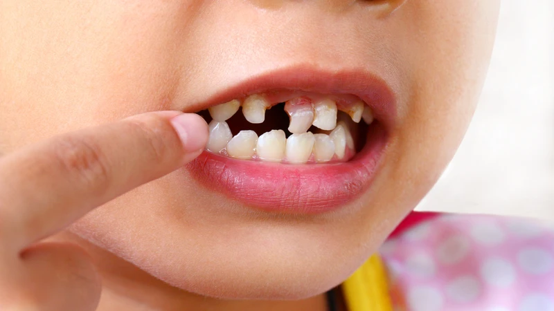 Cung hàm thiếu chỗ có thể khiến răng vĩnh viễn mọc lệch