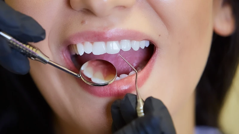 Điều trị sớm giúp bảo tồn răng thật và hạn chế nguy cơ nhiễm trùng lan rộng