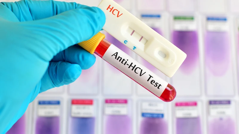 Xét nghiệm HCV Ab miễn dịch tự động là phương pháp phát hiện sự hiện diện của kháng thể kháng HCV trong máu