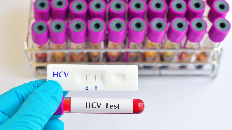 Xét nghiệm HCV Ab miễn dịch tự động có nhiều ưu điểm vượt trội
