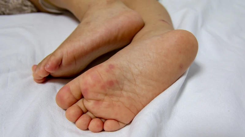 Tay chân miệng độ 2 được phân loại dựa trên tiêu chí nào? Nguyên nhân gây bệnh là gì? 1