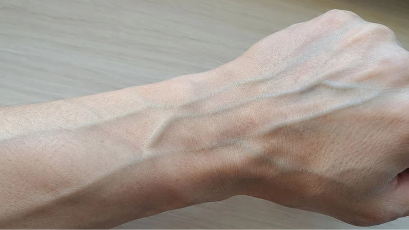 Viêm tĩnh mạch có thể khiến vùng mạch máu bị sưng đau và làm các đường gân xanh hiện rõ dưới da