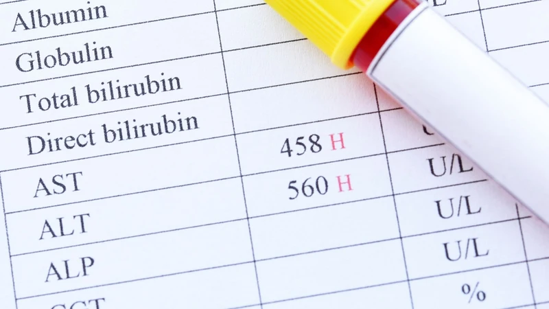 Điểm MELD hỗ trợ đánh giá nguy cơ tử vong trong 90 ngày ở người bệnh gan nặng