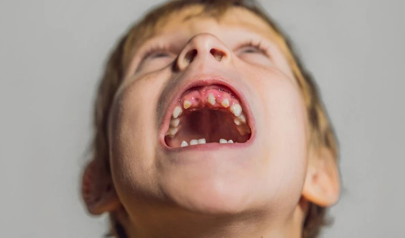Trẻ bị dính thắng lưỡi có nói được không? 1
