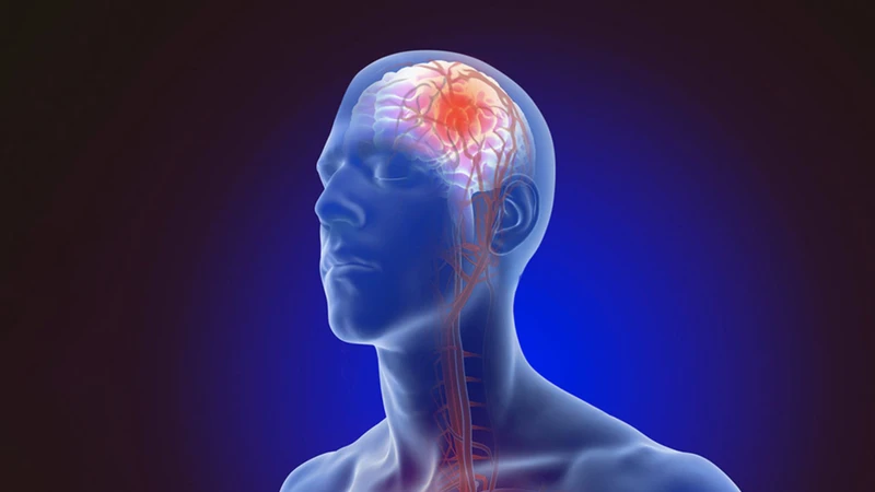 Thiếu máu não nếu không được điều trị kịp thời có thể dẫn đến tổn thương nghiêm trọng ở não