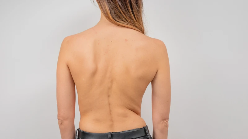Thoái hóa cột sống là gì? Nguyên nhân, triệu chứng và điều trị 2