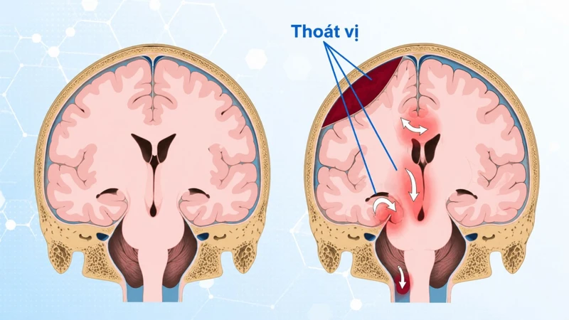 Thoát vị não xảy ra khi mô não bị đẩy khỏi vị trí bình thường