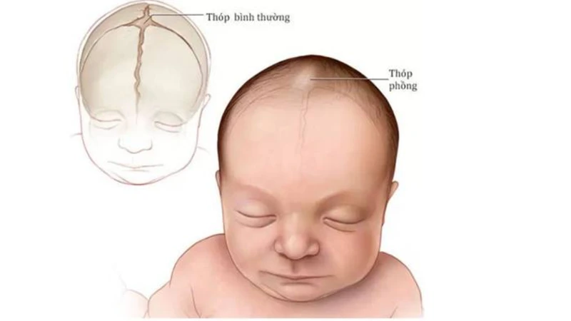 Thóp trẻ sơ sinh có chức năng gì? Những thông tin quan trọng ba mẹ cần biết 3