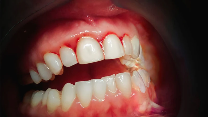 Chảy máu chân răng thường xuyên, nếu không xử lý sớm thì dễ tiến triển thành viêm nha chu nguy hiểm