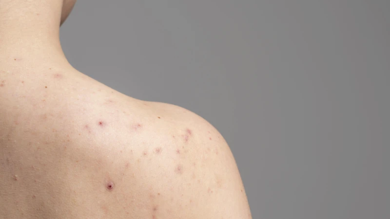 Zona xuất hiện khi virus thuỷ đậu hoạt động trở lại