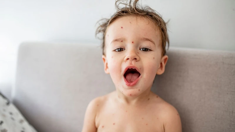 Thủy đậu đóng vảy đã khỏi chưa? Dấu hiệu nhận biết và cách xử lý đúng cách 2