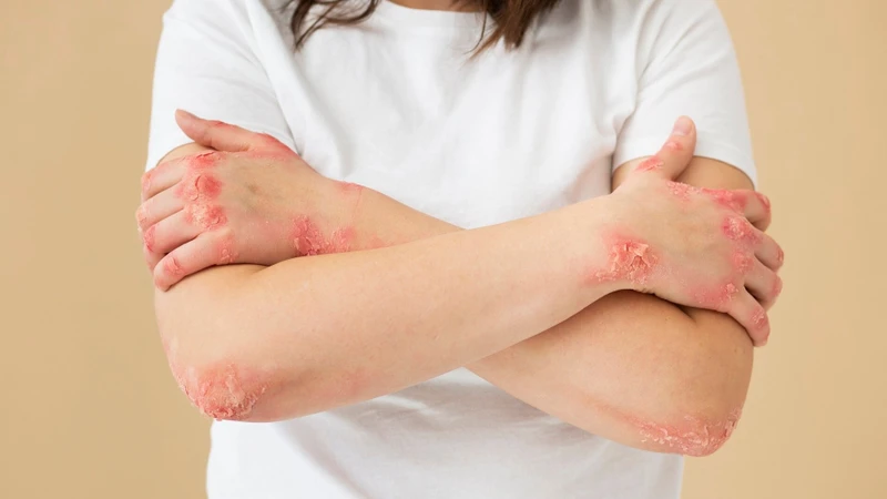 Các mụn nước thủy đậu dễ bị vỡ do gãi hoặc vệ sinh không đúng cách