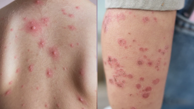 Thủy đậu và tay chân miệng: Phân biệt, chăm sóc và phòng ngừa hiệu quả cho trẻ nhỏ 1