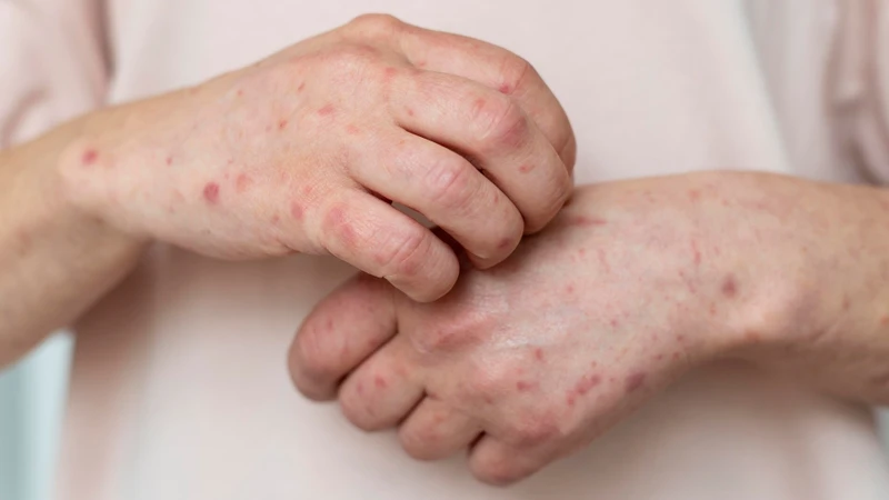 tiep-xuc-voi-nguoi-benh-soi-2.jpg