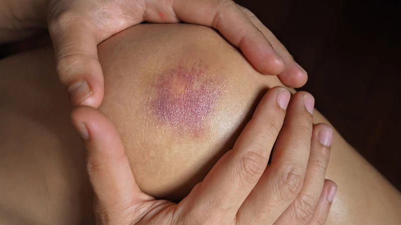 Các vết bầm có thể hình thành sau những va chạm nhẹ hoặc thậm chí không rõ nguyên nhân do khả năng cầm máu bị suy giảm