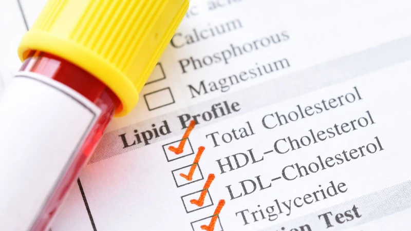 Hiểu tiêu chuẩn chẩn đoán rối loạn lipid máu giúp chủ động kiểm soát sức khỏe