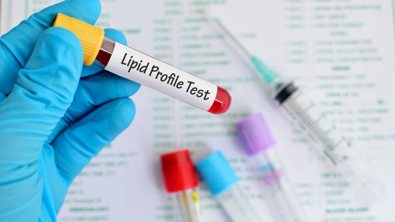 Phát hiện sớm rối loạn lipid máu giúp ngăn ngừa nguy cơ biến chứng xơ vữa động mạch và bệnh tim mạch