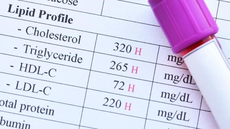 Xét nghiệm lipid máu giúp đánh giá đầy đủ các chỉ số Cholesterol và Triglycerid