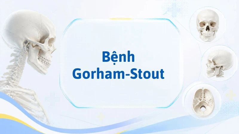 Bệnh Gorham-Stout có thể là một nguyên nhân gây tiêu xương sọ