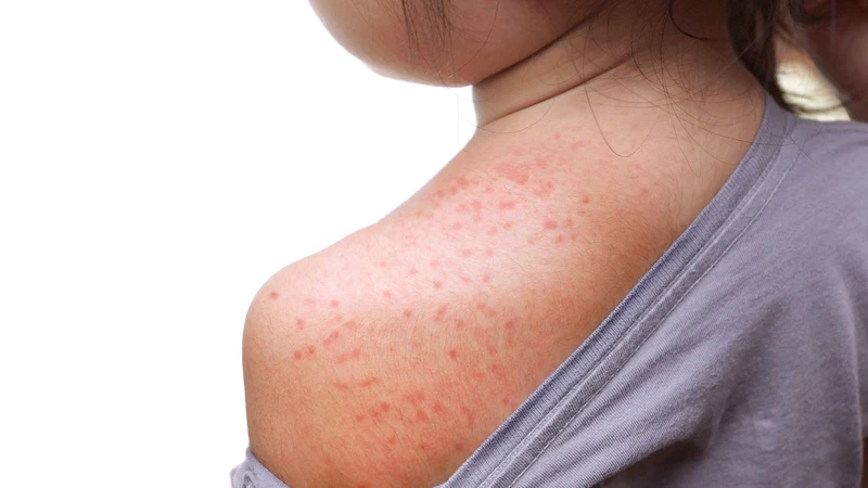 Bệnh thường lành tính, tự khỏi sau 1 tuần và không để lại biến chứng lâu dài