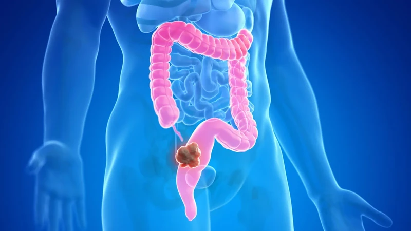 Tìm hiểu nội soi cắt polyp đại tràng và những lưu ý quan trọng cho người bệnh 3