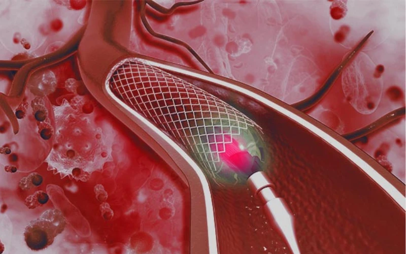 Tùy thuộc vào mức độ chèn ép mà bác sĩ có thể chỉ định nong tĩnh mạch và đặt stent để cải thiện tình trạng chèn ép