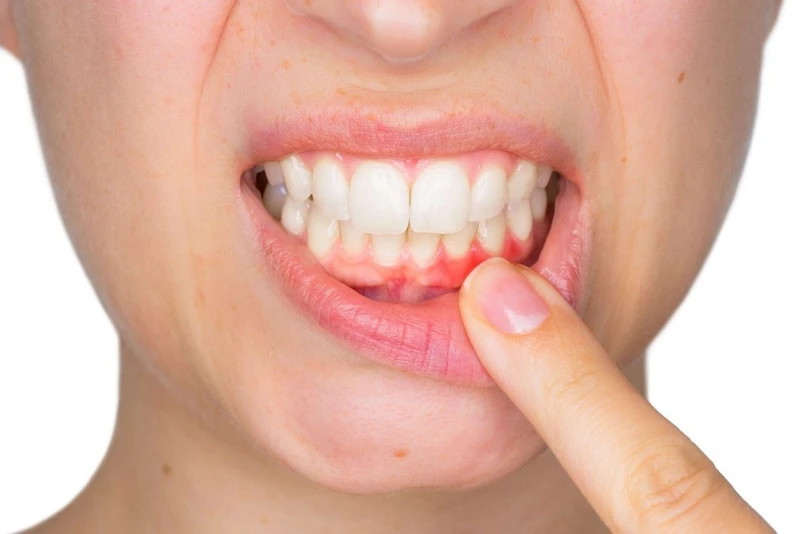 Viêm nha chu là một trong những nguyên nhân dẫn đến răng chết tủy