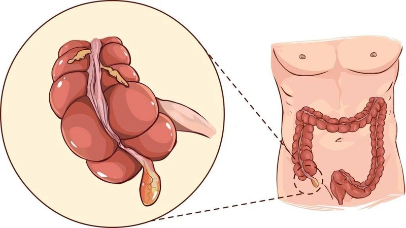 Viêm ruột thừa ở trẻ em là một bệnh lý cấp cứu ngoại khoa xảy ra khi ruột thừa bị viêm nhiễm