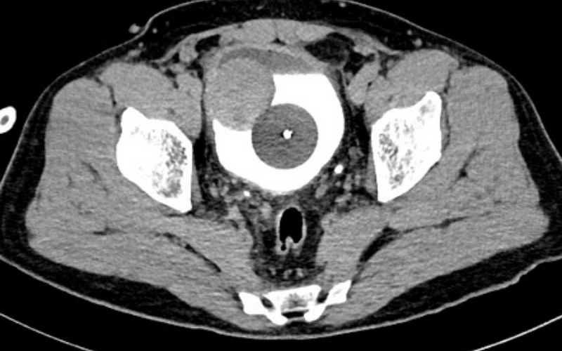 Chụp CT-scan giúp phát hiện vị trí, kích thước u cơ trơn bàng quang