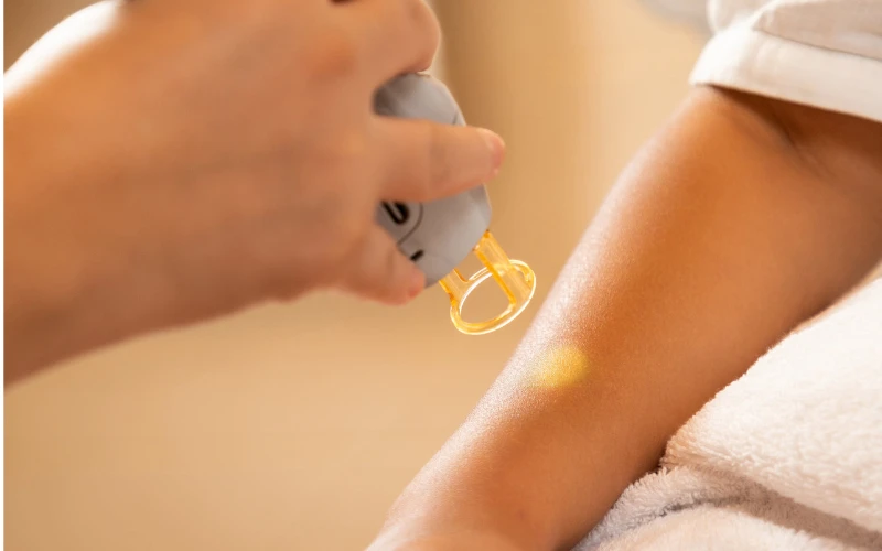 Một số nốt u cơ trơn da kích thước nhỏ có thể được chỉ định đốt điện hoặc đốt laser