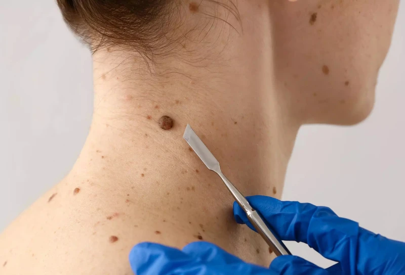 Nốt ruồi thay đổi kích thước, màu sắc cũng cần chú ý và thăm khám kịp thời