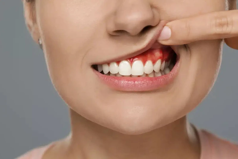 Viêm chân răng có mủ là tình trạng vi khuẩn xâm nhập vào tủy răng hoặc mô nướu gây&nbsp;nhiễm trùng và hình thành áp xe tại chân răng