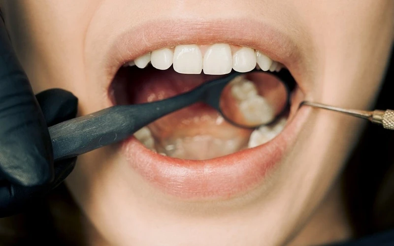 Viêm nướu triển dưỡng có thể làm tích tụ cao răng và mảng bám