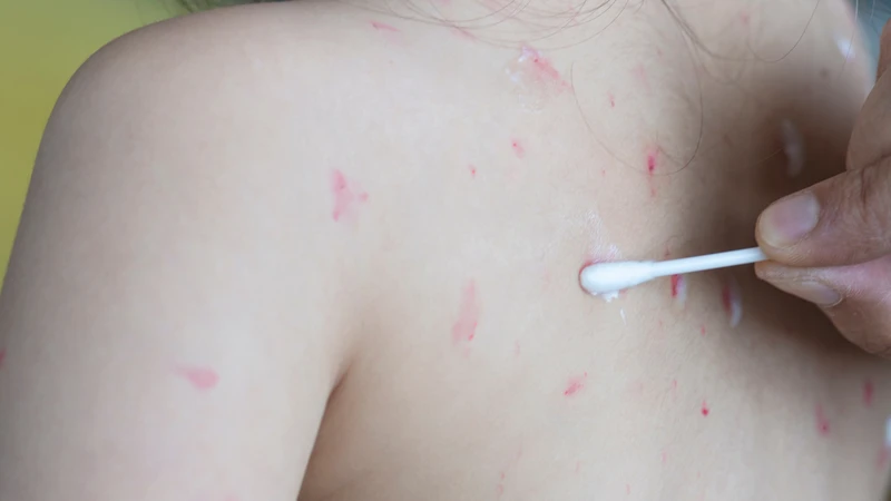 Thuốc bôi thủy đậu chứa kháng sinh cần dùng đúng chỉ định