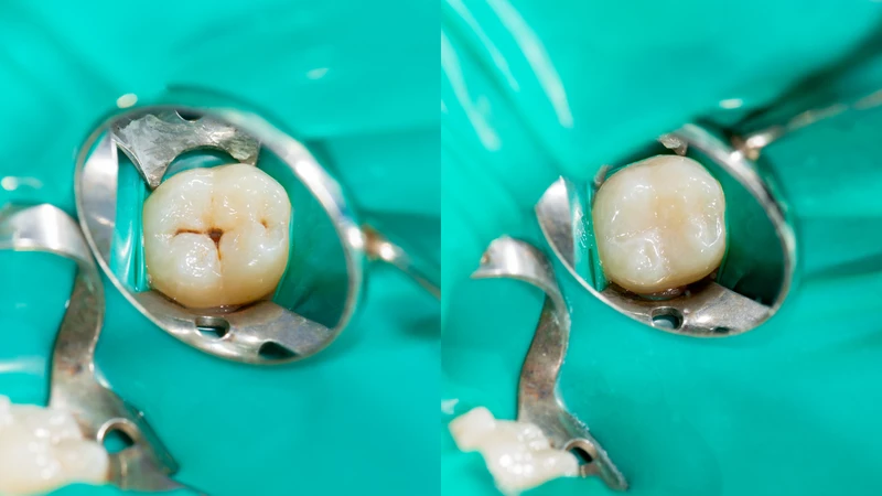 Trám răng rồi có bị sâu lại không?