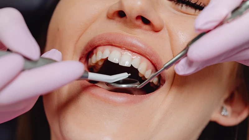 Trám răng sâu giúp loại bỏ phần răng sâu, lấp đầy lỗ hổng, bảo tồn răng thật và ngăn sâu răng lan rộng