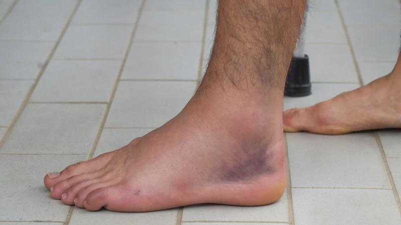 Tràn dịch khớp cổ chân xảy ra khi lượng dịch trong khớp tăng cao bất thường