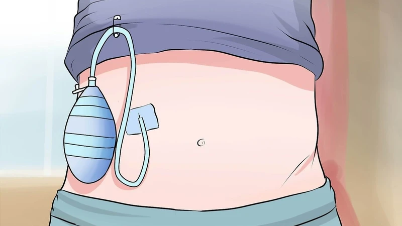 Chọc dò màng bụng giúp loại bỏ dịch