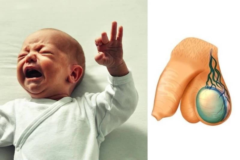 Tràn dịch màng tinh hoàn ở trẻ sơ sinh là gì? Có nguy hiểm không? 1