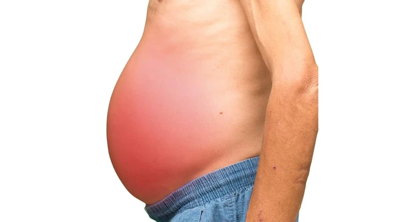 Tràn dịch ổ bụng: Nguyên nhân, triệu chứng và phương pháp điều trị