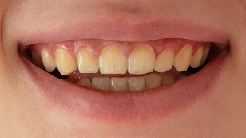 Tráng men răng giúp cải thiện màu sắc, điều chỉnh hình dáng răng, mang lại nụ cười đều đẹp tự nhiên